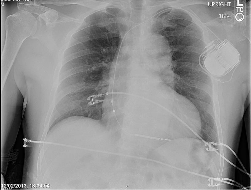 New Choices for ICD Implants | DAIC